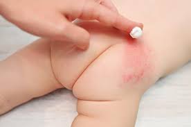 3 Sai Lầm Khiến Bé Dễ Bị Hăm Tã Dù Mẹ Đang Dùng Bỉm Tốt