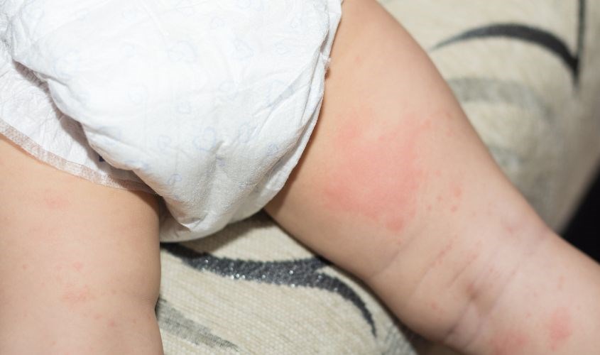 Dấu hiệu nhận biết bé đang bị dị ứng bỉm mẹ cần lưu ý